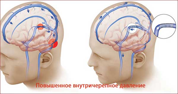 Повышенное внутричерепное давление